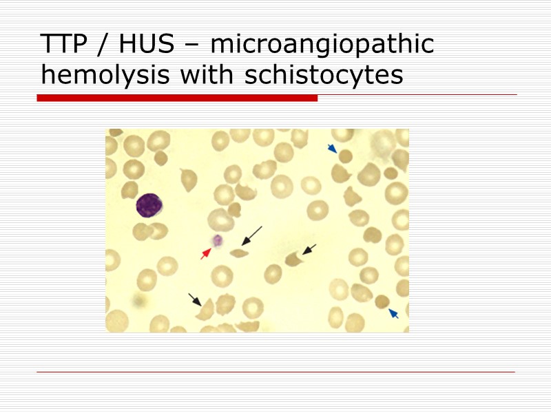 TTP / HUS – microangiopathic hemolysis with schistocytes